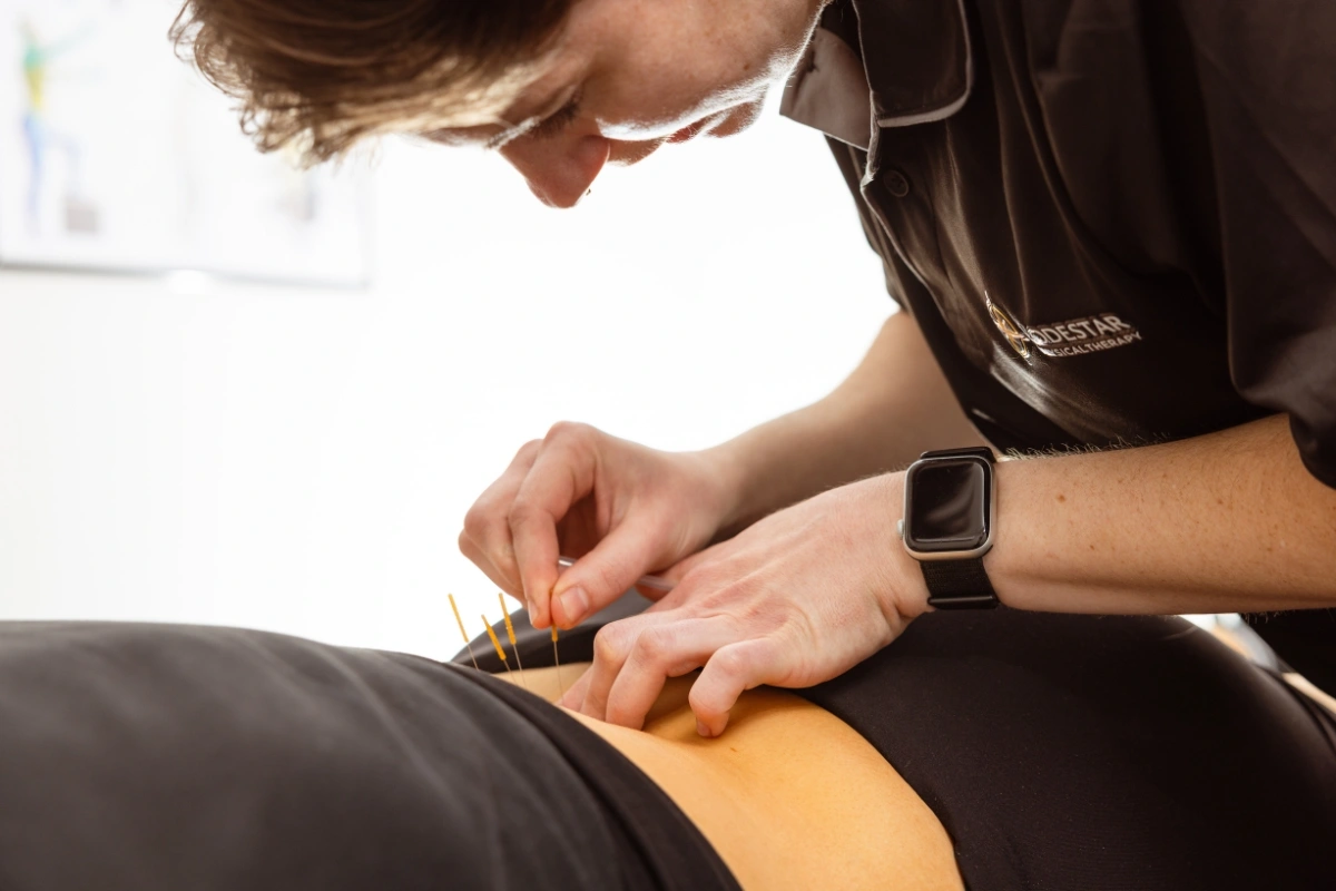 Clinician performing dry needling trigger-point treatment